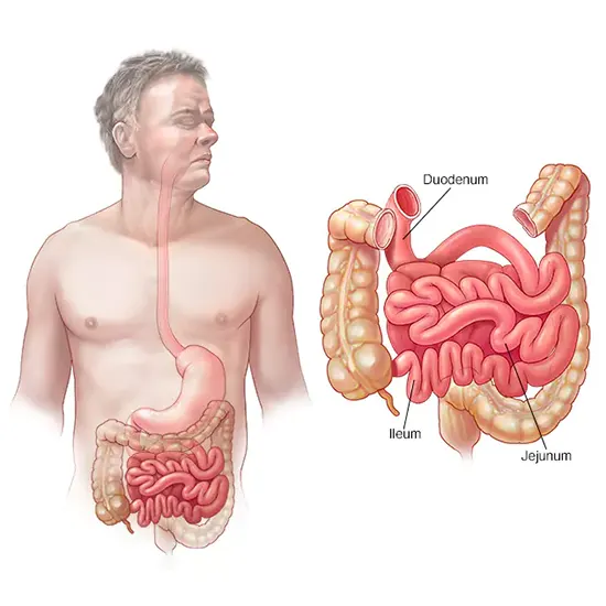 Small Intestine Cancer - Symptoms, Types, Causes & Diagnosis